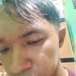 Terulang Dianiaya, Seorang Pria Warga Rawajati Lapokan Istri Sirih ke Polda Metro Jaya